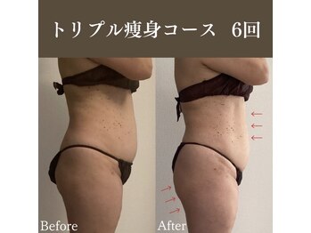 サロンドペシェ(salon de peche)/50代/トリプル痩身６回の変化