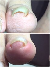 モアクリスタル(More Crystal)/巻き爪補正