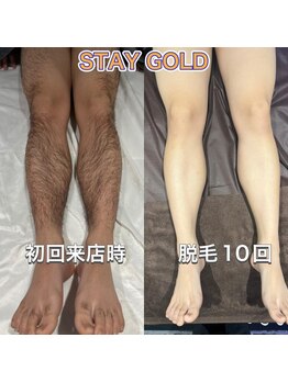 ステイゴールド 新百合ヶ丘(STAY GOLD)/脚脱毛も終盤☆経過報告!!!