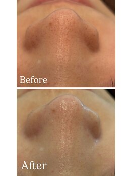 グラサヴォーグ 金沢店/硬い黒ずみをホワイト美肌に(^^)