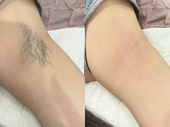 キカ(kika)/ワキワックス＋美容脱毛