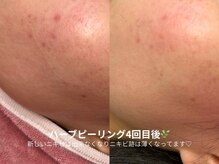 ピブ(pib.)/跡の改善経過