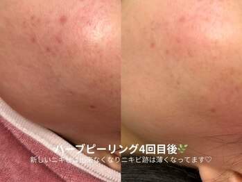 ピブ(pib.)/跡の改善経過