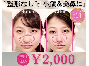 ラプリ 大宮店(Raplit)/隆鼻＋輪郭矯正40分10回