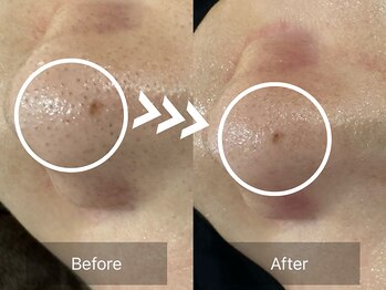 ケアナ 梅田店(CareNa)/毛穴悩みもすっきり/黒ずみケア