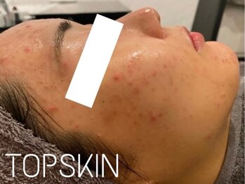 トップスキン 栄(TOPSKIN)/肌質改善専用ハーブ【TCLINE】