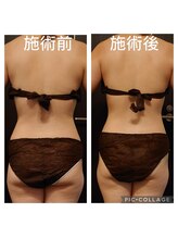 フロレゾン(Floraison)/筋膜ケア