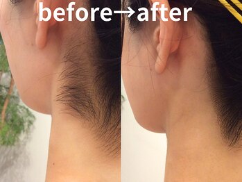 ももとゆでたまご/襟足シェービングbefore→after