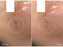 フェイシャルクレア(Cre A.)/ムートン×光フェイシャル