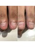 【キャンペーン価格/男性ハンド】即日バレずに深爪矯正