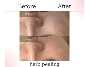 サロンツキ(salon tuki)/ハーブピーリング症例