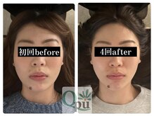 キュープ 富士店(Qpu)/お顔の間延び感も改善します