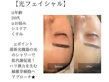 サロンツキ(salon tuki)/光フェイシャル/徳島/シミケア