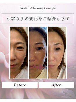 トータルビューティー筋膜ケアサロン カンスタイル(Kanstyle)の写真/【美肌×脱毛】最先端IPL脱毛！毛穴引き締め＆美白ケアでツルツル美肌へ★都度払いOKで自分のペースで◎