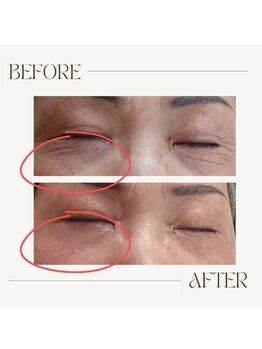 ニワ(Niwa)/バザルトフェイシャル施術例