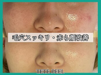 ヴィオール 名古屋栄店(VIOR)/TETEピール　赤ら顔改善
