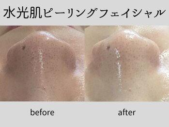 マーベル(MaaBelle)/30代/水光肌ピーリング