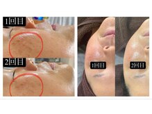 サマラボ 三軒茶屋(Sama Labo)/Before→After(シミ緩和)