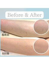 ニコ(Nico)/足脱毛