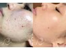 【本気のニキビ改善】リベルハーブピーリングで圧倒的効果を実感