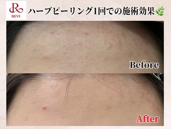 エヌ(N)の写真/REVIハーブピーリングで輝く肌へ！肌の悩みに合わせてカスタマイズする特別なケアを★