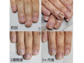 深爪矯正の3ヶ月後
