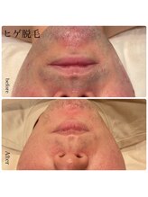 エクラ(eclat)/髭脱毛