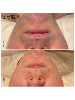 エクラ(eclat)/髭脱毛