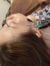 ハリファ鍼灸院 横浜関内院(HariFa鍼灸院)/美容施術/美容鍼