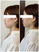 メディカルエース(MedicalAce)/BTXサーマ×脂肪燃焼