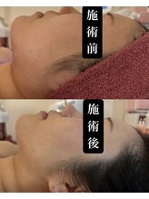 フェミニー(Feminy)/【小顔整顔リフト】輪郭矯正