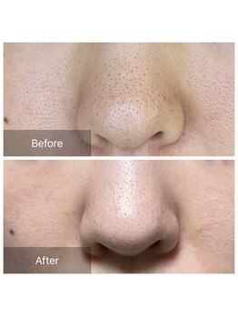 ノルン(Norn)/ハーブピーリング☆