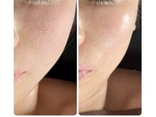 ラグーン(Lagoon)/WINBACK