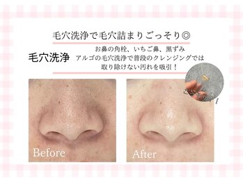 アルゴ 熊本玉名店(ALGO)/いちご鼻卒業☆毛穴洗浄