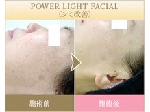 ビューティースペース 品川大井町店(Beauty Space)/光フェイシャル