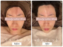 リノ(Lino)/ブライダルエステでご来店♪