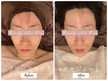 リノ(Lino)/ブライダルエステでご来店♪