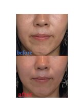 ルディア 堂島店(ledia)/40代女性　美容鍼1回目での変化