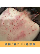 いつつのき/スライドカッピング×鍼×SSP