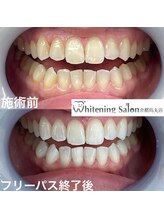 ホワイトニングサロン 京都烏丸店/ホワイトニング施術例