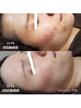 ビーピー 渋谷(b.p.)/ニキビケア ハーブピーリング