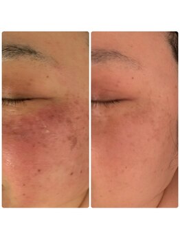 ジョルジオ東京/2Bバイオ×光トーニング