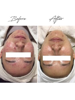 ビズビズ 梅田店(bisebise)/背中ニキビ/ハイドラ毛穴洗浄