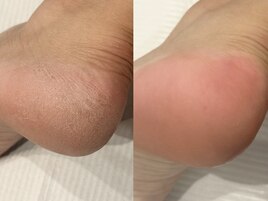 フット角質ケア