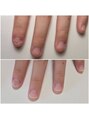エムユーファイブネイル(MU5-nail)&nbsp;深爪矯正 自爪育成