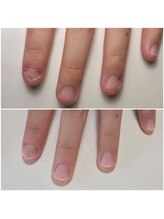 エムユーファイブネイル(MU5-nail)&nbsp;深爪矯正 自爪育成