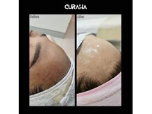 夏のダメージ肌お手入れキュラハ月2回のキュラハで韓国美肌