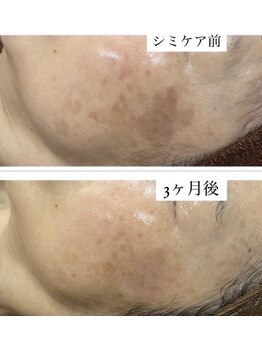 ミニョン(Mignon)/60代女性シミケア改善写真