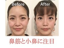 ラプリシュシュ 岡山店(Raplit)/隆鼻＋輪郭矯正40分10回