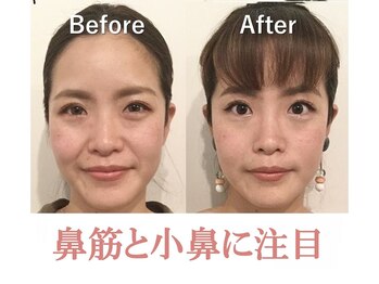 ラプリシュシュ 岡山店(Raplit)/隆鼻+輪郭矯正40分10回